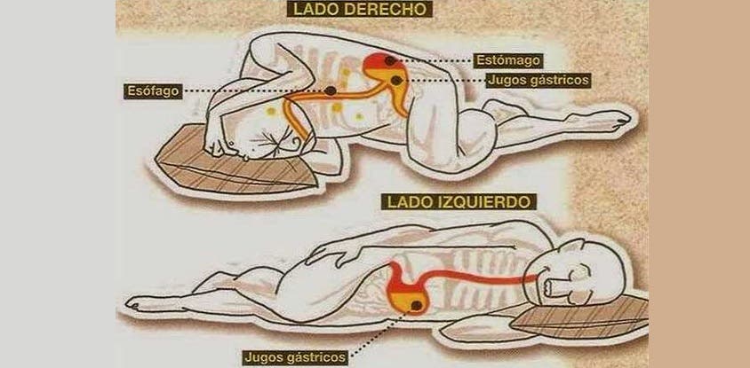 La osteocondrosis lumbar lumbosacra