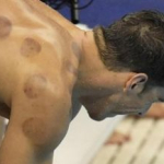 ¿Qué son las marcas que tiene Michael Phelps en la espalda?